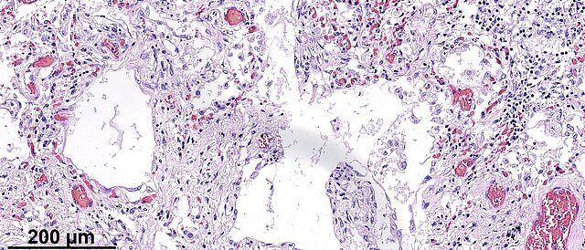 Mikroskopische Aufnahme von geschädigtem Lungengewebe infolge einer COVID-19 Erkrankung, Hämatoxylin-Eosin-Färbung, 20-fache Vergrößerung