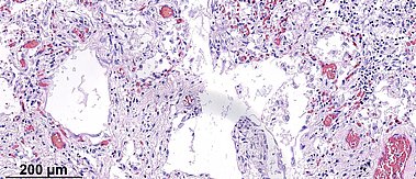 Mikroskopische Aufnahme von geschädigtem Lungengewebe infolge einer COVID-19 Erkrankung, Hämatoxylin-Eosin-Färbung, 20-fache Vergrößerung