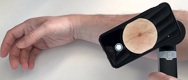 Melanom-verdächtige Läsionen werden mit einem Smartphone und einem aufgesetzten Dermatoskop fotografiert. Ein auf künstlicher Intelligenz basierendes Assistenzsystem gibt anschließend retrospektiv eine Einschätzung ab, ob es sich dabei um Melanome handelt. Die Diagnose und Therapieentscheidung werden demnach dabei noch nicht beeinflusst.