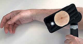 Melanom-verdächtige Läsionen werden mit einem Smartphone und einem aufgesetzten Dermatoskop fotografiert. Ein auf künstlicher Intelligenz basierendes Assistenzsystem gibt anschließend retrospektiv eine Einschätzung ab, ob es sich dabei um Melanome handelt. Die Diagnose und Therapieentscheidung werden demnach dabei noch nicht beeinflusst.