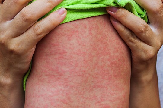 Foto: rot gepunkteter Oberarm eines Patienten