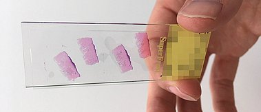 Mit Hilfe von Künstlicher Intelligenz könnte an Gewebeschnitten das Tumorverhalten vorausgesagt werden.