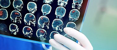 Foto: Hand mit Handschuh hält Röntgenbild. Darauf abgebildet diverse Aufnahmen eines Schädels mit vermutlich Gehirntumor.