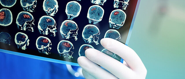 Foto: Hand mit Handschuh hält Röntgenbild. Darauf abgebildet diverse Aufnahmen eines Schädels mit vermutlich Gehirntumor.